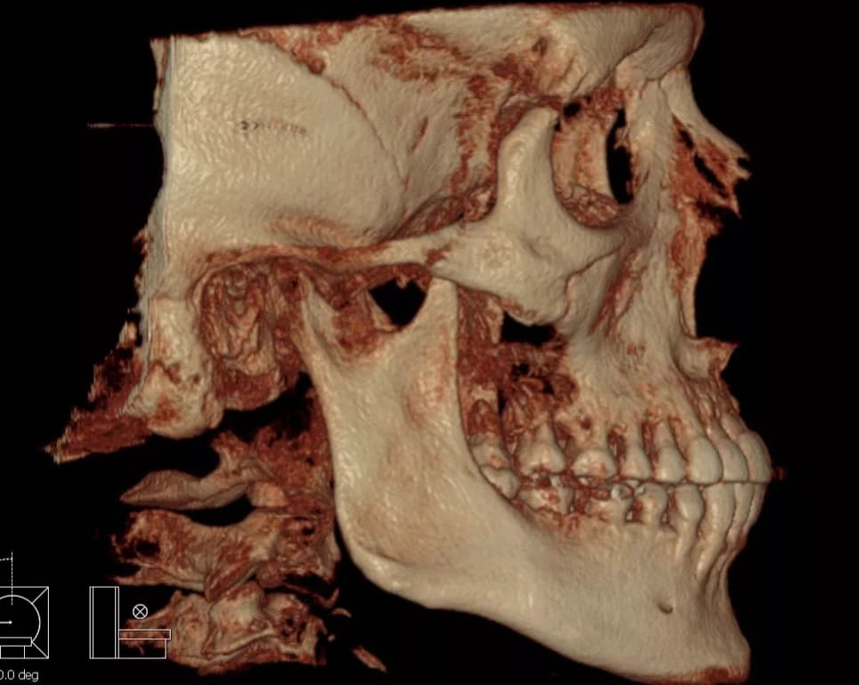 Компьютерная томография челюсти