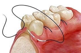 Хирургическое вмешательство при воспалении зуба