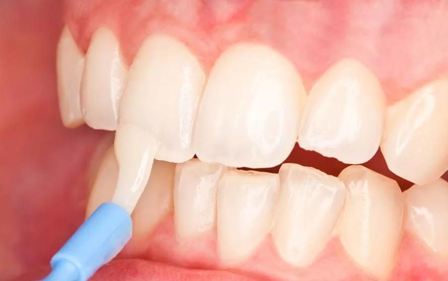 Почему зубы становятся прозрачными: основные причины и способы предотвращения