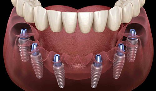 Имплантация зубов All-on-6